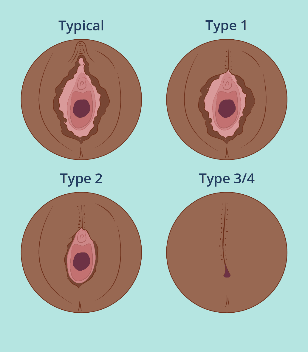 illustration of the different types of FGC